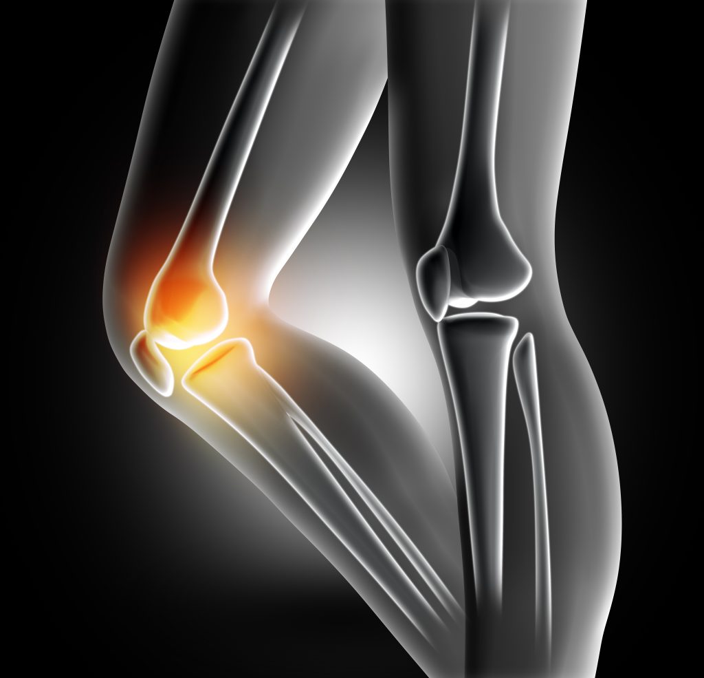 3D render of a female medical legs with bones in knee highlighted