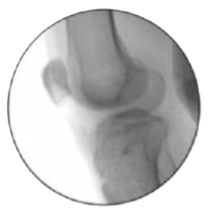 Fluoroscopy of the Knee